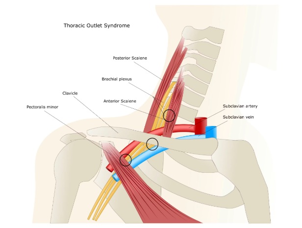 The thoracic outlet consists of three distinct anatomical spaces: the interscalene triangle between the scalene muscles, the costoclavicular space between the first rib and clavicle, and the sub-pectoralis minor space. Compression or irritation of the neurovascular bundle within any of these regions—often due to muscular abnormalities, a first rib anomaly, or a cervical rib—can lead to Thoracic Outlet Syndrome (TOS).