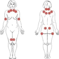 Tačke bola zastupljene kod fibromijalgije