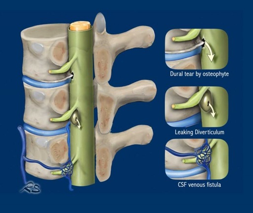 Types of spinal CSF leak