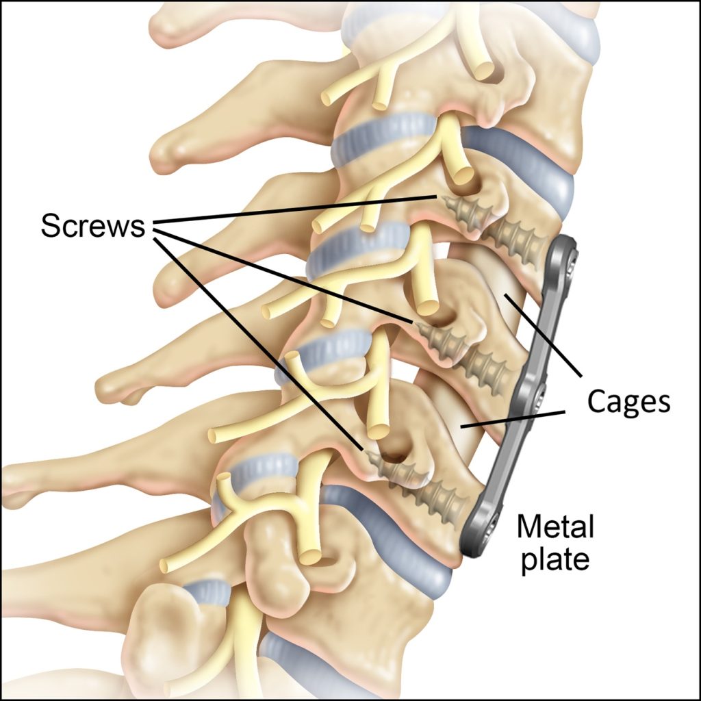  ACDF complications explained – Instead of the removed discs, cages were inserted, and subsequently, a metal plate was screwed in from the front with screws to increase the stability of both segments. Sometimes, backward displacement of these cages can occur, which may lead to compression of the spinal cord or nerve roots. Instability can also occur despite the plate.