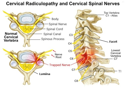 Anatomy of the cervical spine showing seven vertebrae (C1–C7), eight nerve roots, intervertebral discs that act as flexible shock absorbers, and posterior articulations between vertebrae called facets. Also presented is a disc herniation at the C6–C7 level compressing the C7 cervical nerve root.
