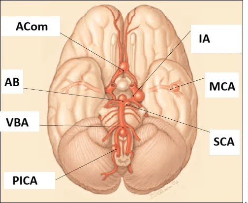 Najčešće lokalizacije aneurizmi mozga: ACom – prednja komunikantna arterija; IA – unutrašnja karotidna arterija; MCA – srednja moždana arterija; AB – bazilarna arterija; VBA – vertebrobazilarni spoj; SCA – gornja cerebelarna arterija; PICA – zadnja donja cerebelarna arterija. Aneurizme su najčešće lokalizovane na mestima grananja arterija Willisovog kruga, pretežno u prednjoj moždanoj cirkulaciji.