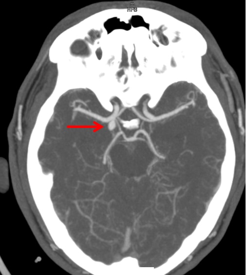 Ct angiografija (CTA) prikazuje arterije mozga. Crvena strelica prikazuje aneurizmu zadnje komunikantne arterije (PCom)
