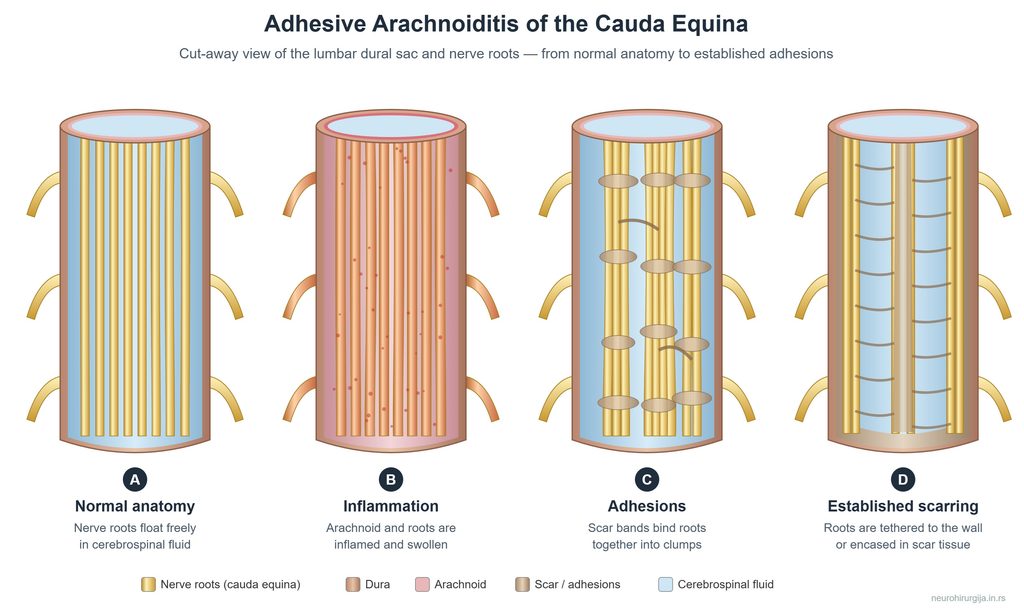 Stages of arachnoiditis involving the cauda equina.