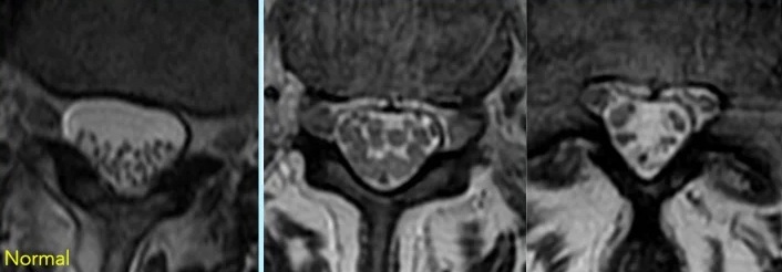 Three classical MRI patterns of adhesive arachnoiditis involving the cauda equina.