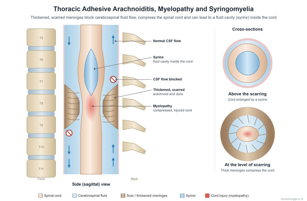 Arachnoiditis causing myelopathy and syringomyelia.